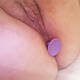 plug anale
